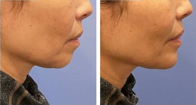 Mentoplastia caso 1 — antes y después